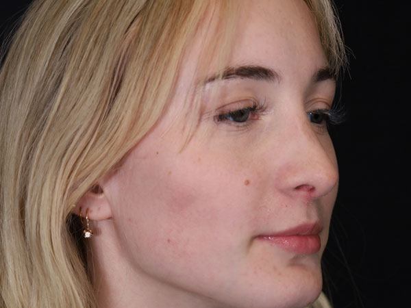 Rhinoplasty Patient 51 After 1