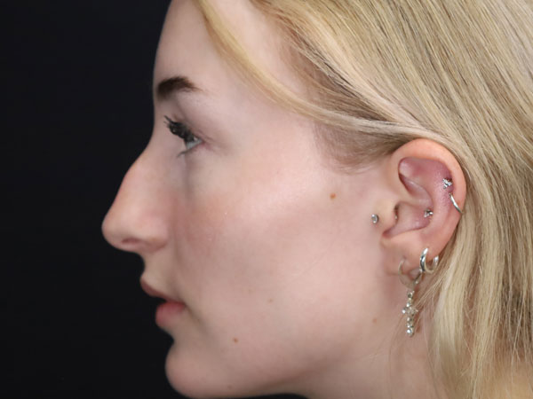 Rhinoplasty Patient 51 Before 2