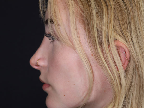 Rhinoplasty Patient 51 After 2