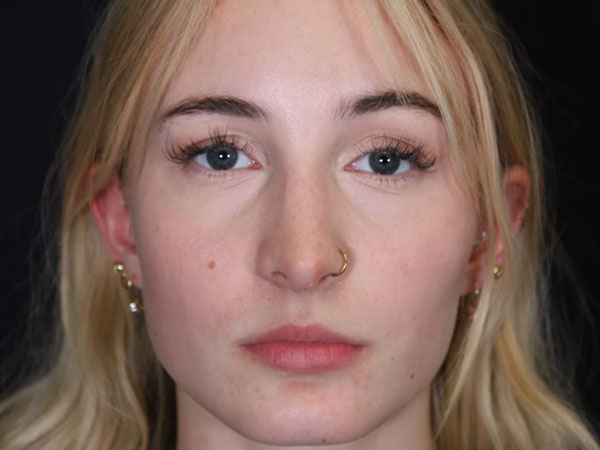 Rhinoplasty Patient 51 After 3