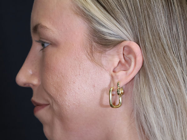 Rhinoplasty Patient 52 After 3