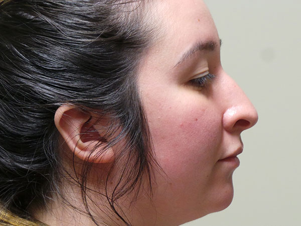 Rhinoplasty Patient 44 Before 1