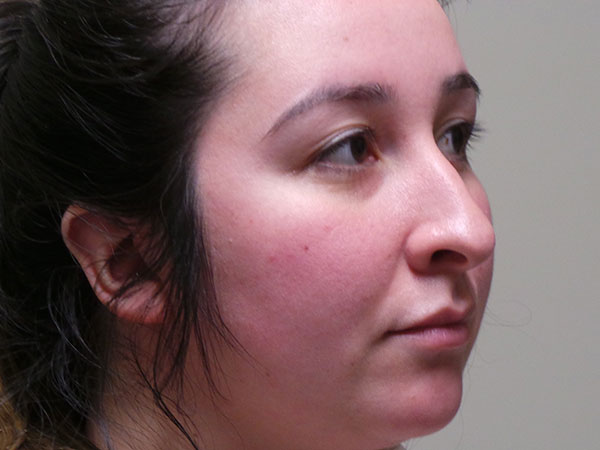 Rhinoplasty Patient 44 Before 2