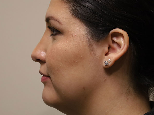 Rhinoplasty Patient 45 After 1