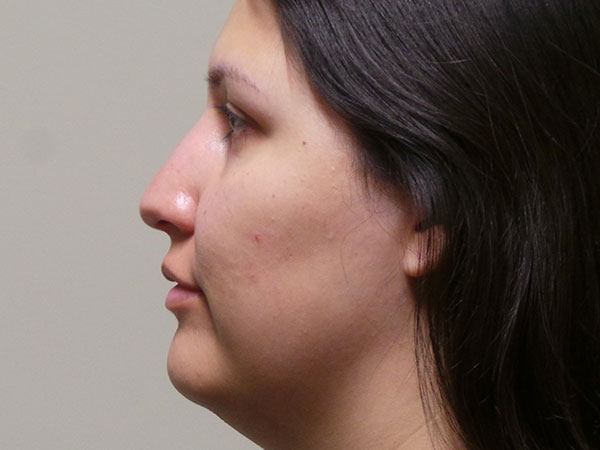 Rhinoplasty Patient 45 Before 1
