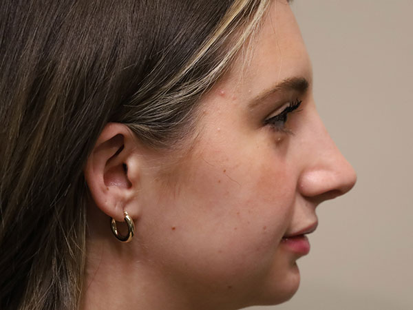 Rhinoplasty Patient 46 After 1