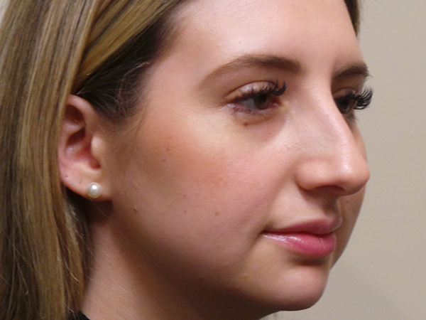Rhinoplasty Patient 46 Before 2