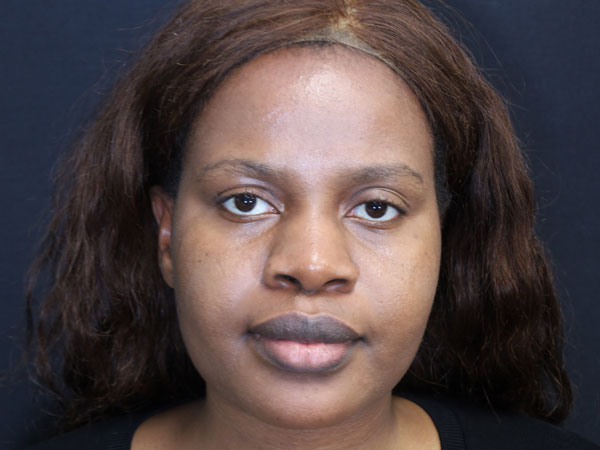 Rhinoplasty Case 53 Before 1