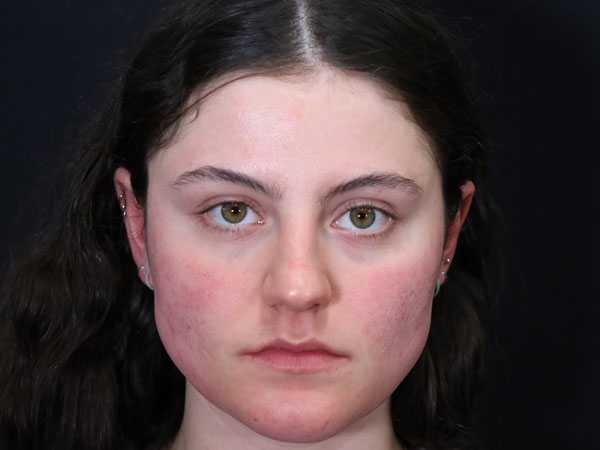 Rhinoplasty Case 54 Before 1