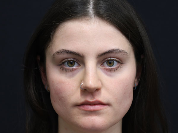 Rhinoplasty Case 54 After 1