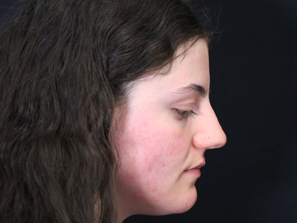 Rhinoplasty Case 54 Before 2