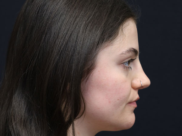 Rhinoplasty Case 54 After 2