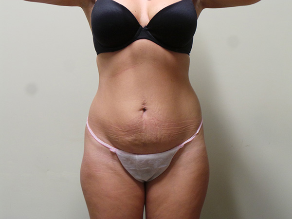 Tummy Tuck Patient 22 Before 1