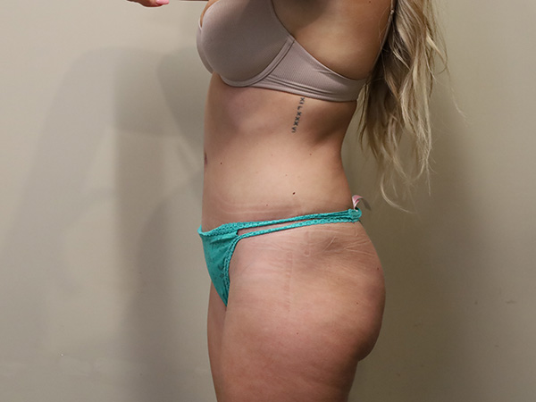 Tummy Tuck Patient 22 After 2